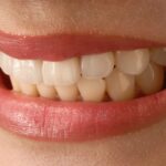 Thorough Manual for No Prep veneer: Cost, Method, and Advantages
